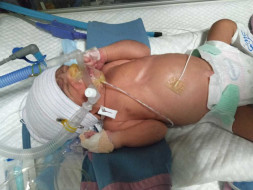 Help Baby Boy for Exploratory Laparotomy Surgery