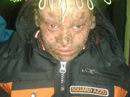 Help Prince Fight Rare Skin Disease
