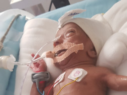 Help Baby Of Shalini: Premature Birth