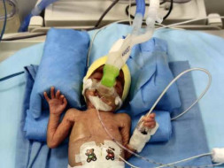 Help My preterm baby to recover