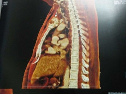Help My Father Recover From Bone tumor