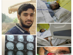 My Brother Is Struggling With Multiple Skulls, Facial Bones Fracture And Brain Injury, Help Him