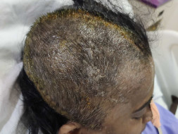 My Mom is struggling with cerebrovascular accident, Help her !