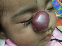 3 Months Old Rashmika Needs Your Help Fight Hemangioma