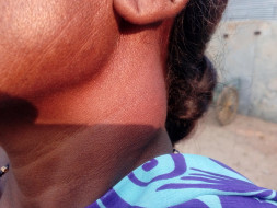 Help My Mother Fight Nasopharyngeal Cancer