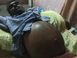 Support Kalla Anantha Undergo Liver Transplant