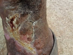 Support Satyanarayana Recover From Ulcer Wound In Left Leg