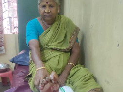 My Mother Is Struggling With Foot Infection, Help Her