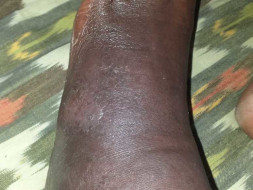 Support N.Srinivas Recover From Cellulitis