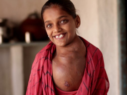 Help Girl with crippling tumour on neck