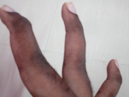 I’m struggling with Fractured fingers, help me