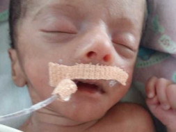 Support New Born Baby Recover From Breathing Problems