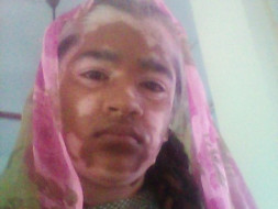 14 Years Old Thaseena Needs Your Help Fight Impingement Syndrome