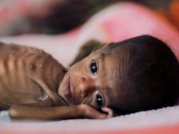 Nutrition for 300 Malnourished children
