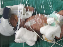Open Heart Surgery. Twin Babies are born Preterm , Please Help