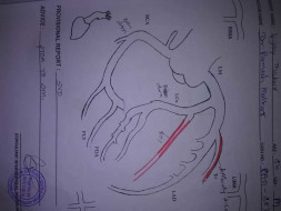 Help Me to Undergo Angioplasty Surgery