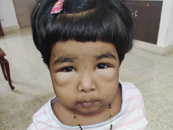 This 5 Years Old Needs Your Urgent Support In Fighting Nephrotic Syndrome