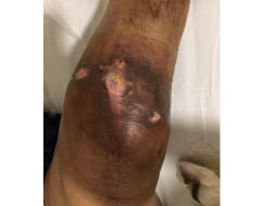Support My Mother in Fight From Knee Infection because of Surgery