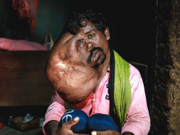 Help Manbodh Undergo Treatment For Facial Tumor