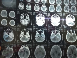 This 14 years old needs your urgent support in fighting Brain tumor