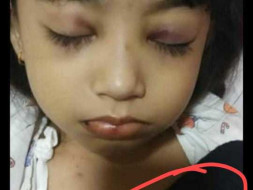 Help Bristi Deka to Fight Leukemia (Blood Cancer)