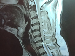 Help my daddy for Cervical Compressive Myelopathy surgery