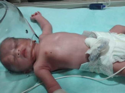 Support Baby of Aman Bhogal Recover From Congenital Megacolon