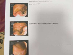 My Cousin Is Struggling With Rectal Cancer, Help Her