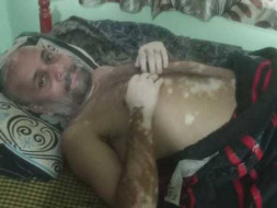 Support Rajesh Singh Thakur Recover From Mental Retardation & Vitiligo