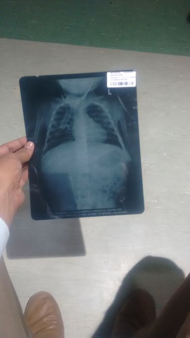 Lung Xray