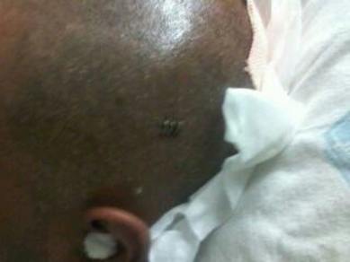 1st Surgery pic