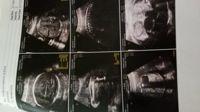 ULTRASONOGRAPHY AT THE AGE 1MONTH