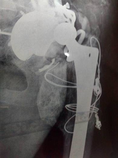 reconstructed acetabulum ( hip joint)
