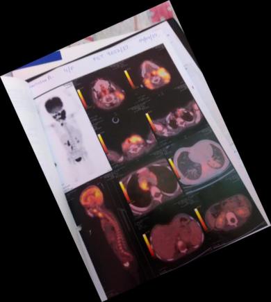 PET-Scan Report