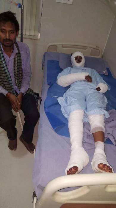 Young Daughter Gayatri - Severely Burnt