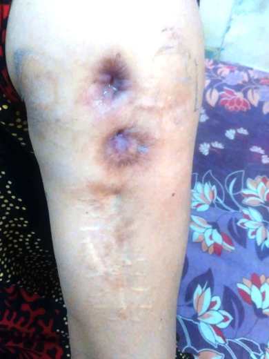 Left arm - damage