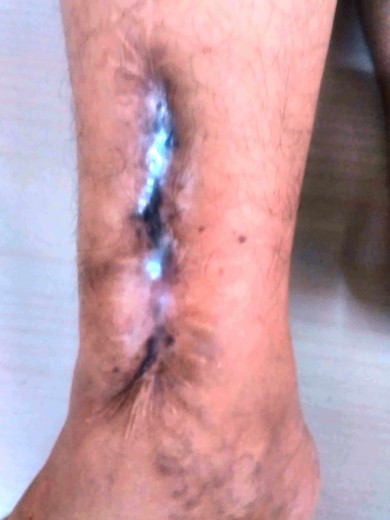 Right leg - Damage