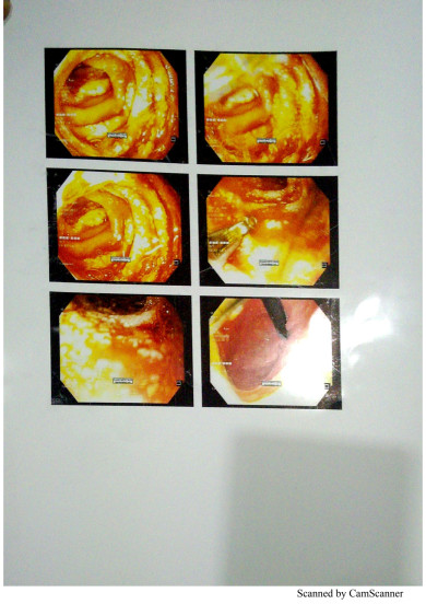 Endoscopy recent