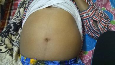 Ascites - Abdominal (peritoneal) cavity