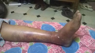 Edema foot