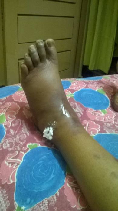 Swelling