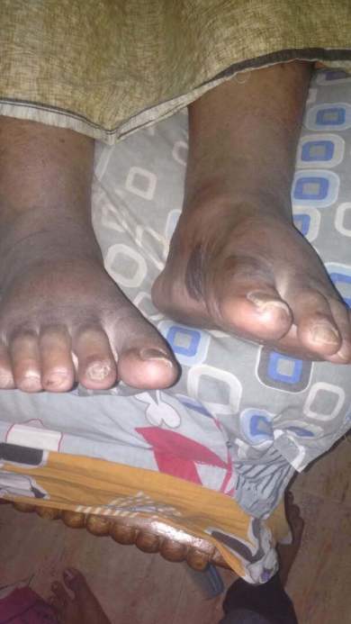 Edema formed in his legs and black scars