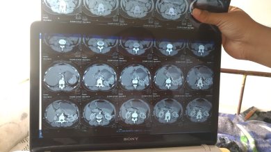 CT scan