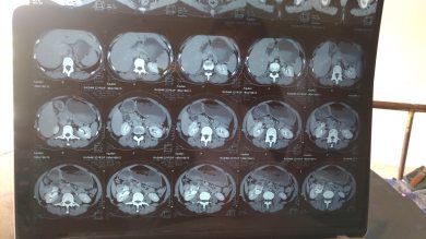 CT Scan
