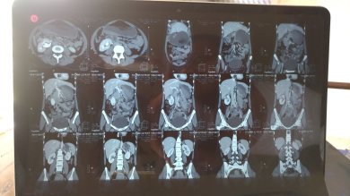 CT Scan