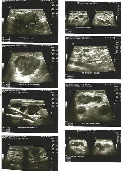 X-RAY MAMMOGRAPHY BOTH BREAST -B