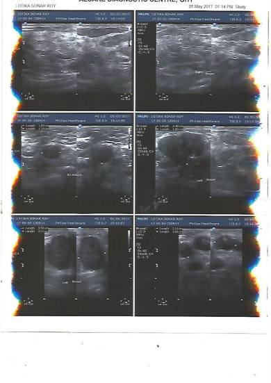 USG OF BOTH BREASTS - B