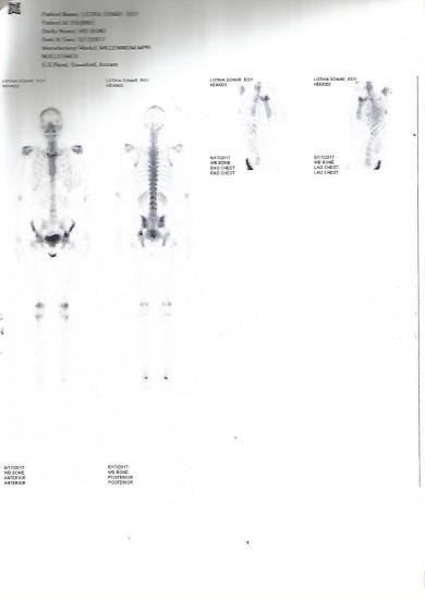 NUCLEAR BONE SCAN B