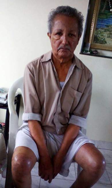 Skin infection due to kidney failure