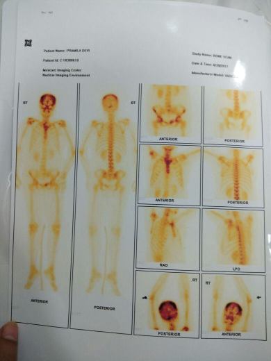 Bone Scan